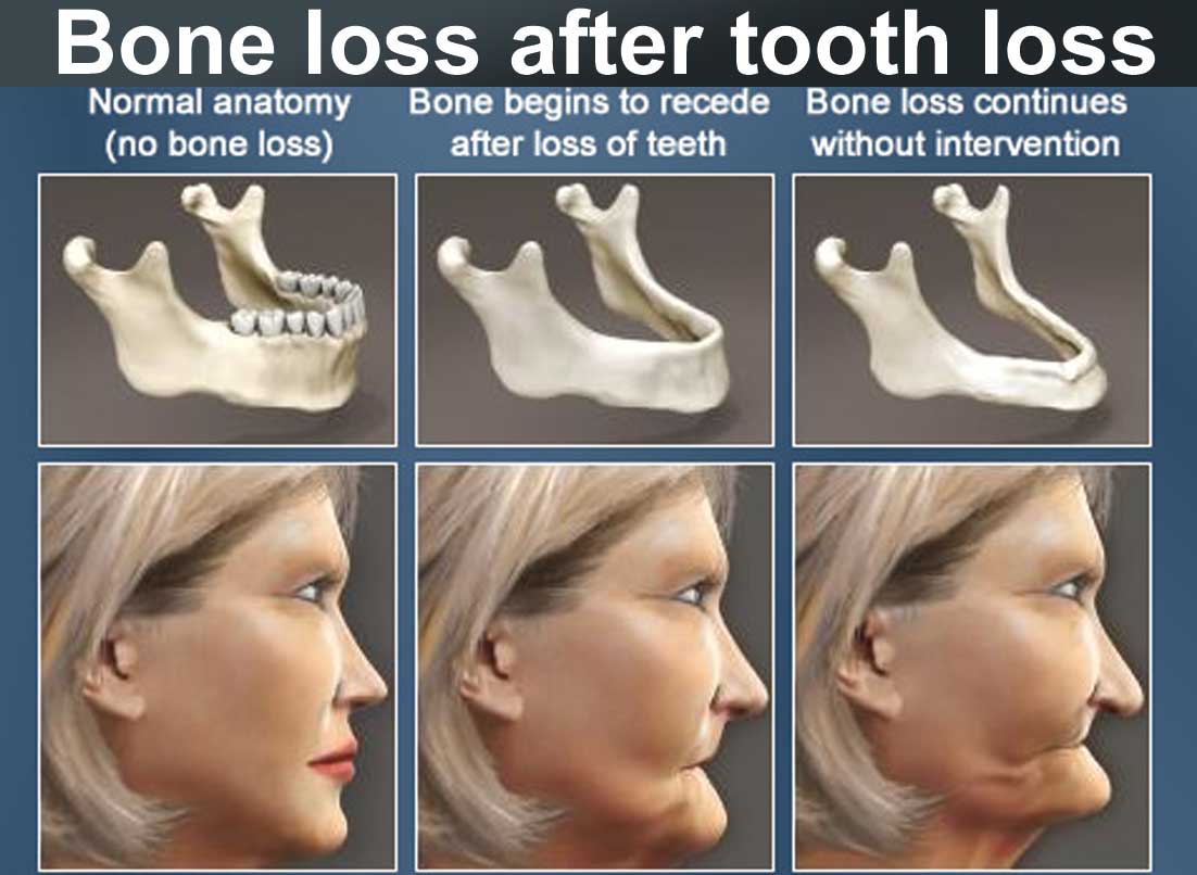 bone loss